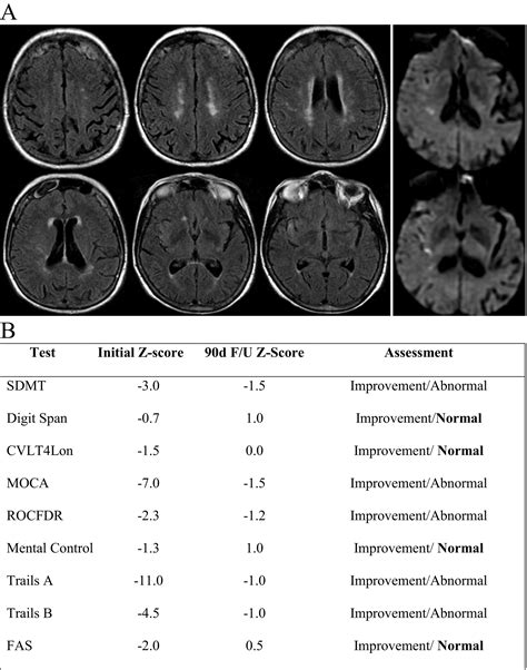 minimoca|Cognitive deficits in acute mild ischemic stroke and.